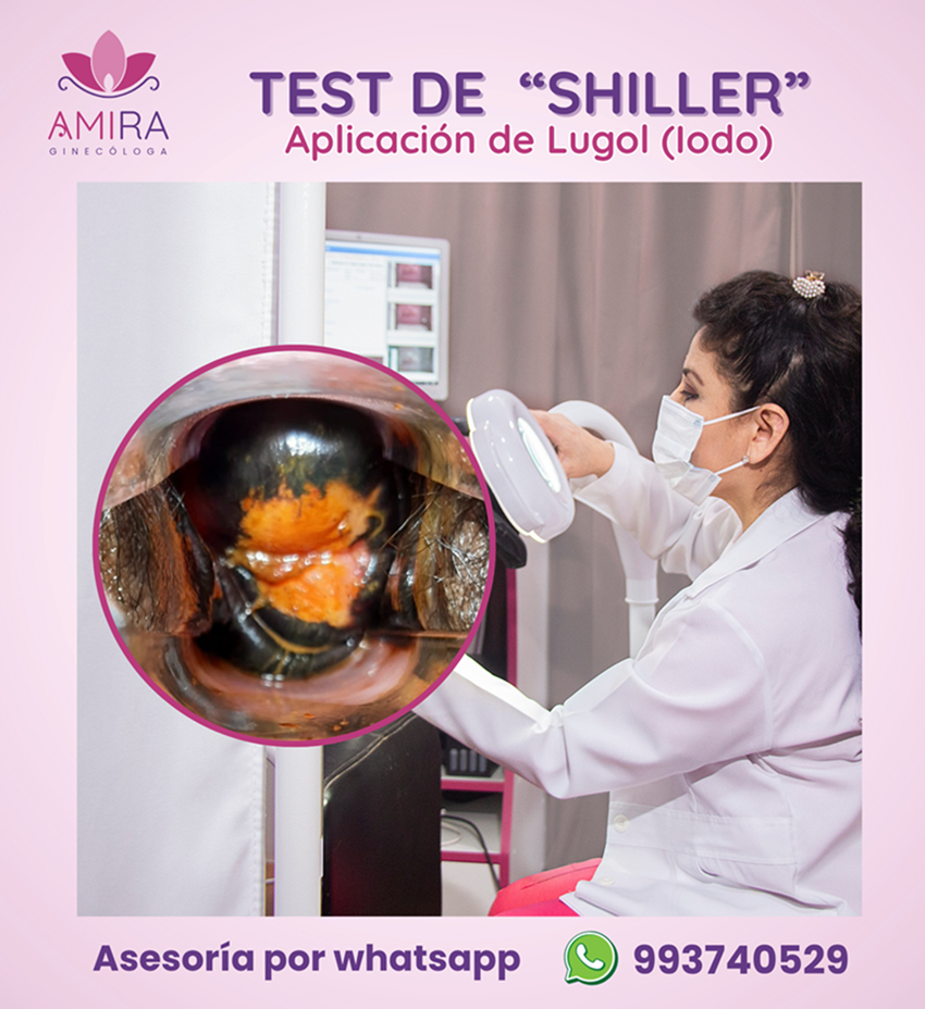 Amira Ginecologa Obstetra - Test de Shiller (Prueba del Lugol)