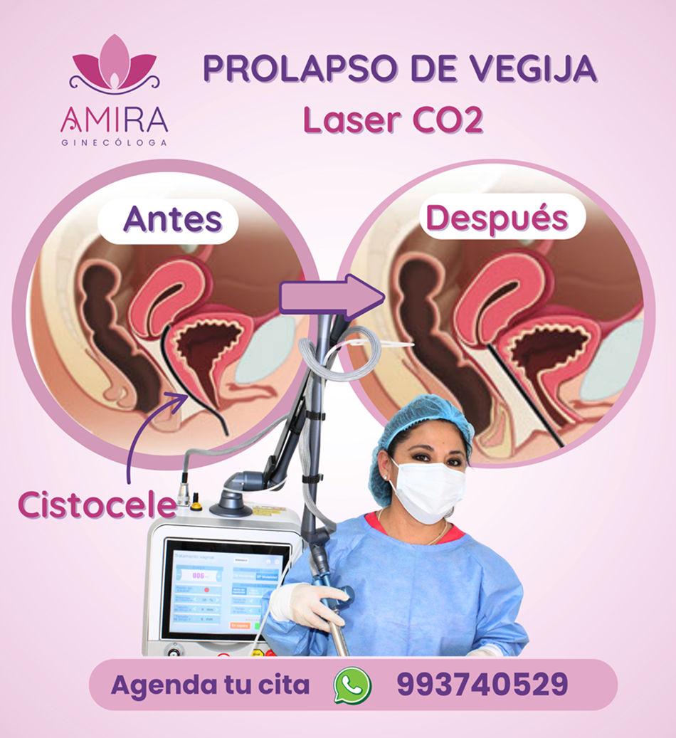 Amira Ginecologa Obstetra - PROLAPSO DE VEGIJA