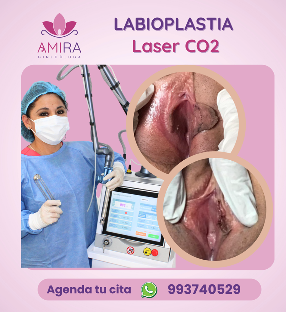 Amira Ginecologa Obstetra - LABIOPLASTIA