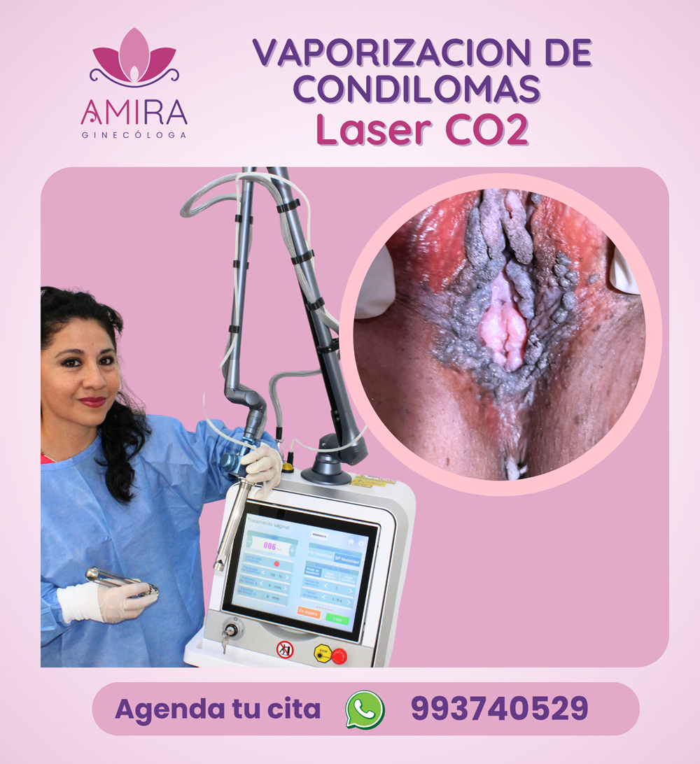 Amira Ginecologa Obstetra - VAPORIZACION DE CONDILOMAS