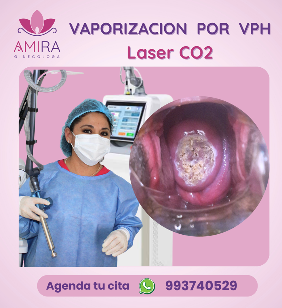 Amira Ginecologa Obstetra - VAPORIZACION DE NIC I PERSISTENTE