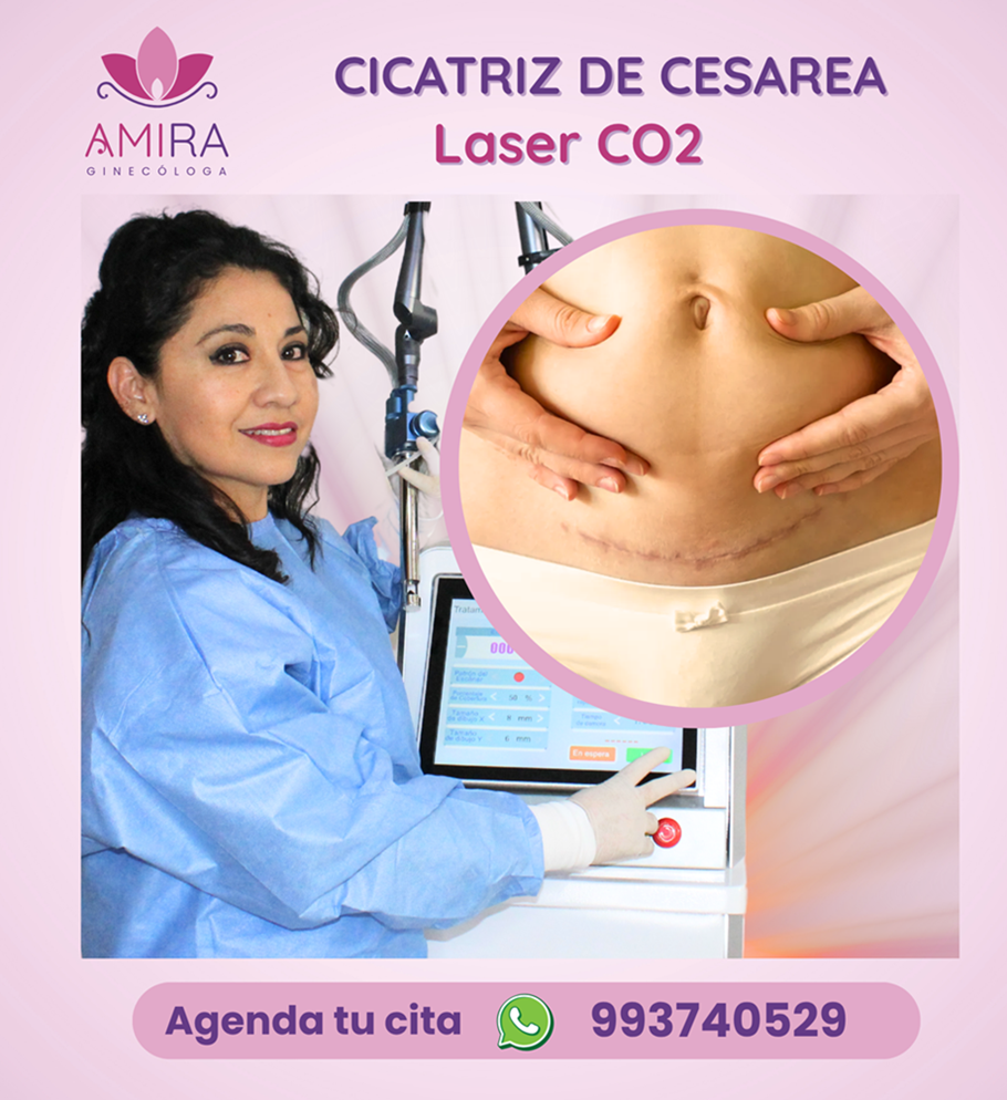 Amira Ginecologa Obstetra - TRATAMIENTO DE LA CICATRIZ DE CESAREA