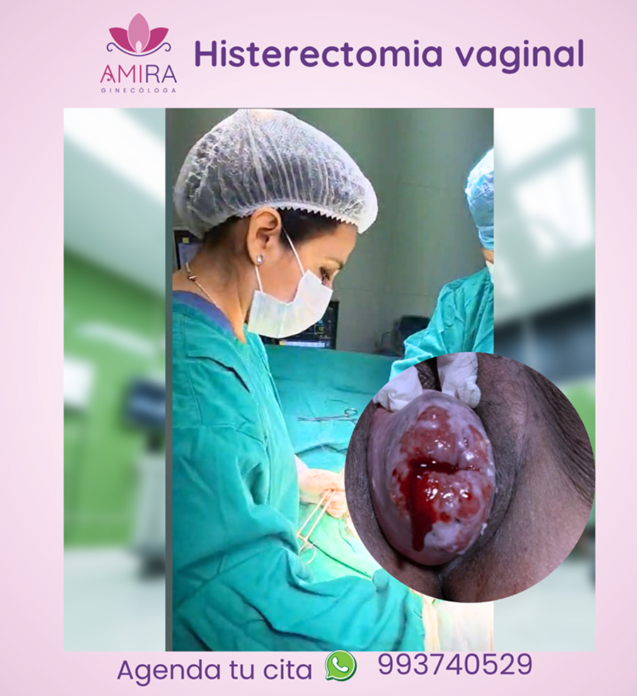 Amira Ginecologa Obstetra - HISTERECTOMIA VAGINAL