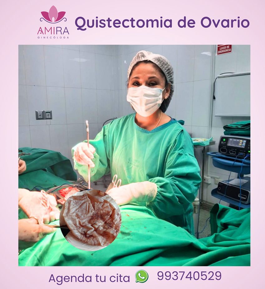 Amira Ginecologa Obstetra - QUISTECTOMIA  DE OVARIO