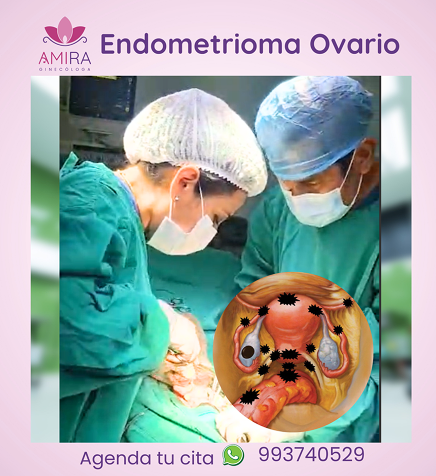 Amira Ginecologa Obstetra - ENDOMETRIOMA  EN OVARIO