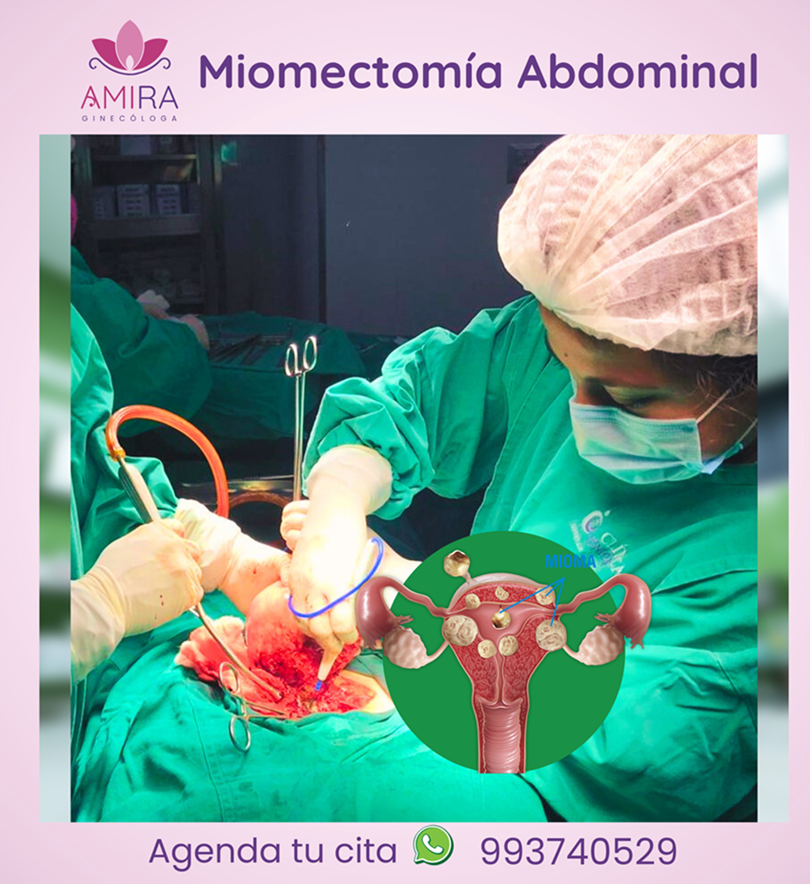 Amira Ginecologa Obstetra - MIOMECTOMIA ABDOMINAL