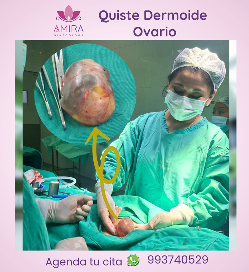 Amira Ginecologa Obstetra - QUISTE DERMOIDE EN OVARIO