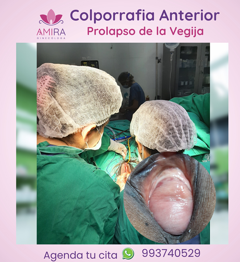 Amira Ginecologa Obstetra - COLPORRAFIA   ANTERIOR